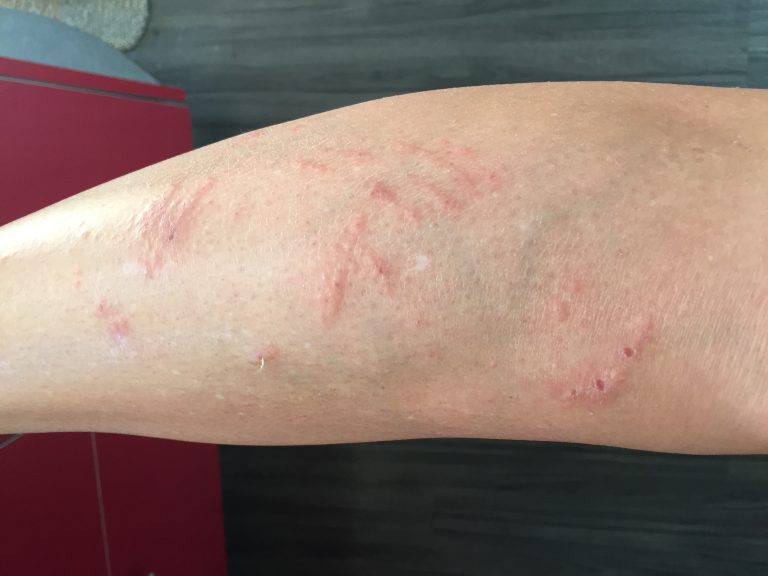 poison ivy rash on shin